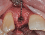 Figure 13 A 3.3-mm x 12-mm NC SLActive implant in place with 3 mm of bone buccal to the placed implant. Note the bone regeneration gained on the distal of tooth No. 8.