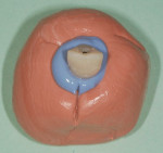 Figure 18 The provisional attached to a Straumann NC analog, which is embedded in quick-setting bite material to capture
the subgingival contours. The buccal aspect was noted with a line scribed on the midbuccal aspect in the material.