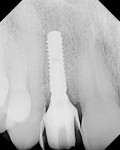 Figure 16 A digital periapical radiograph of the screw-retained provisional.