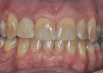 Figure 15 The screw-retained provisional at 8 weeks. The final “blueprint” of the transitional zone had thus been developed.