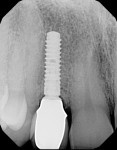 Figure 25 Final digital periapical radiograph 1-year post-insertion showed stable osseous healing. (restorative dentistry performed by
Steven Present, DMD, North Wales, Pennsylvania)