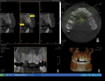 Figure 9 A CBCT scan taken 6 months post-GBR showed significant bone fill and vertical augmentation for site No. 7. Close adaptation of the mesh to the regenerated bone confirmed minimal to no micromovement of the mesh during healing as a result of excellent mesh stabilization during the healing phase.