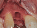 Figure 6 Surgical re-entry to perform titanium mesh GBR procedure at 3 months postextraction. Note the bone loss on the midbuccal of extraction site No. 7 and the distal of tooth No. 8.