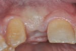 Figure 10 Healing at 7 months with good buccal contours. The site remained closed throughout the healing period. No titanium mesh exposure was noted.