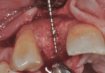Figure 11 Re-entry at 7 months for implant placement confirmed excellent bone healing for implant placement.