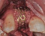 Figure 7 Titanium mesh in-situ stabilized with titanium screws both buccal and palatal. The bone graft was soaked in GEM 21S before placement. The titanium mesh was covered with CollaTape soaked in GEM 21S.