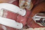 Figure 3 The DentalVibe GEN II was placed at the injection site and activated before inserting the needle.