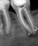 Figure 2 Postoperative radiograph of tooth No. 18. Coronal seal was created with
radiolucent antimicrobial self-etching adhesive (Clearfil SE Protect, arrow) and a radiopaque flowable composite, followed by placement of a cotton pellet and a temporary restoration.