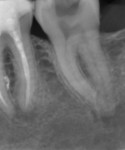 Figure 1 Preoperative radiograph of tooth No. 18. Diagnosis: pulpal necrosis with symptomatic apical periodontitis.