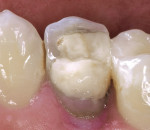 Figure 1  Endodontically treated maxillary second premolar with a defective restoration.
