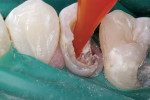 Figure 3  Dual-cure resin cement was injected into the root canal before post cementation.