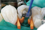Figure 6  Application of dual-cure adhesive (IntegraBond) to the cavity preparation.
