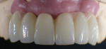 The esthetic result on the model.
