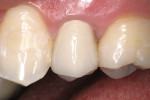 Figure 12a  The all-ceramic crown after cementation.