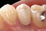 Figure 12b  The all-ceramic crown after cementation.