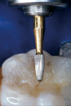 Figure 8  The occlusal margin was finished with a #30 fluted egg-shaped finishing bur.