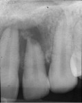 Figure 1 and Figure 2 Case 1: Radiographs of maxillary left central and lateral incisors revealed large periapical radiolucency with some opacities within.