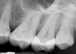 Figure 5 Case 2: Radiograph of vital maxillary left first molar, tooth No. 14, adjacent to the soft-tissue lesion.