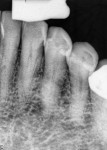 Figure 9 Case 3: Radiograph of tooth No. 22 revealed no periradicular pathology and no decay or restoration.