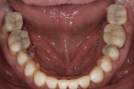 Figure 7 The transitional composite bonding was accomplished using the diagnostic wax-up, and it allowed the occlusion and esthetics to be evaluated before final treatment.