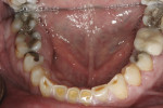 Figure 4 The patient’s lower arch showed severe wear on the incisors and structurally compromised teeth.