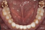 Figure 9 Crown lengthening and pocket reduction surgery helped reduce periodontal and restorative risk.