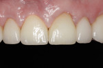 Figure 10 Upper incisors restored with implant in site No. 8.