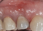 Figure 2 At presentation, clinical buccal view of tooth No. 5 with mid-buccal fistula. The tooth was split in half to the osseous crest.