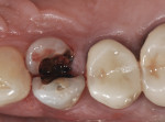 Figure 3 At presentation, clinical occlusal view of tooth No. 5 with split noted along the pulpal floor and mesial marginal ridge.