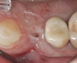 Figure 4 At 8 weeks post-extraction, a significant buccal ridge defect was noted at site No. 5.