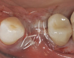 Figure 11 After a buccal periosteal
releasing incision was performed, tension-free closure was achieved with high-density polytetrafluoroethylene (d-PTFE) and 6-0 plain gut sutures, which also closed the vertical releasing incision at tooth No. 4 distally.