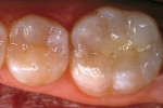 Figure 11  The postoperative occlusal view of the definitive restoration. Note the optical integration andmarginal integrity of the laboratory-processed composite resin onlay with the existing tooth structure.