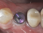 Figure 21 After 8 weeks, a 6-mm conical healing abutment was placed to “stretch the tissues” for better emergence profile.