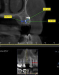 Figure 14 CBCT taken 6 months post-GBR showed significant bone fill and vertical augmentation for site No. 5. Close adaptation of the mesh to the regenerated bone confirmed minimal to no micromovement of the mesh during healing as a result of excellent mesh stabilization during the healing phase.