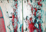 Figure 4 Radicular pulp. “A” shows diffused dystrophic calcification (Gomori’s trichrome, original at 10x magnification); “B” shows the irregular and elongated amorphous structures disposed along the rich web of collagen fiber bundles  (Gomori’s trichrome, original at 20x magnification).