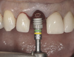 Figure 3 Illustrates insertion of a platform-switched implant with Laser-Lok collar.