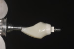 Figure 6 Typical provisional crown contour used to develop
the marginal tissue contour while encouraging maximum soft tissue volume at the
implant–abutment interface.