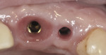 Figure 7 Tissue contour developed with a provisional restoration. This contrasts to the
tissue form of an adjacent non-provisionalized implant.