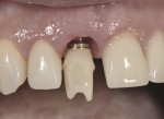 Figure 9 A Laser-Lok abutment
base is cemented extraorally to a zirconium abutment. The literature suggests
that connective tissue will functionally orient to the lased surface and may contribute
to enhanced clinical outcomes by creating a supracrestal tissue barrier to microbial
challenges.
