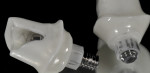 Figure 10 Removal of a zirconia abutment/stem shows metal streaking on the
abutment, indicating imprecision of fit or micromotion at the level of the stem and
resulting in wear and possible deformation of the internal aspect of the implant.