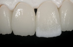 Figure 6  Applying translucent porcelains to the incisal one third to create a more natural effect.