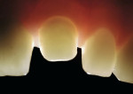 Figure 11  Intraoral view of a transilluminated Spinell coping. Note the natural translucency.