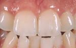 Figure 12  Single central on tooth No. 9 made out of Spinell and Vita VM®7 (Vident).