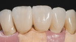 Because the implant position is mesial to the ideal position, these were designed flat on the mesial profile. However, they still posed restorative contouring challenges.