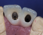 A screw-retained implant fixed partial denture showing ideal implant placement for
lingual screw access.