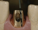 Using a soft-tissue model and a periodontal probe makes it possible to accurately locate an
abutment margin depth.