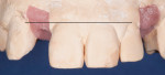This implant has been placed at a normal depth relative to the tissue level of the
site. However, it will be impossible to create a restoration the same length as the contralateral tooth
due to the coronal placement of the implant.