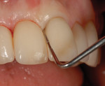 With the implant restoration on tooth No. 8, the interproximal
bone on the mesial of No. 7 and No. 9 can be sounded to verify the appropriate
contact point placement from the proximal crest of bone to ensure complete
regeneration of the interproximal papilla. Photos courtesy of Dr. D Jayne.