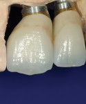 The difficulties of using a stock abutment to restore anterior teeth. The
abutment profile was insufficient, and as such, the margins were lowered to allow
more room to develop the emergence profile.