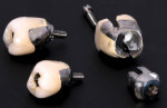 The removal of cement-retained implant
restorations can be difficult and unpredictable,
often requiring the destruction of the crown and
or the abutment.